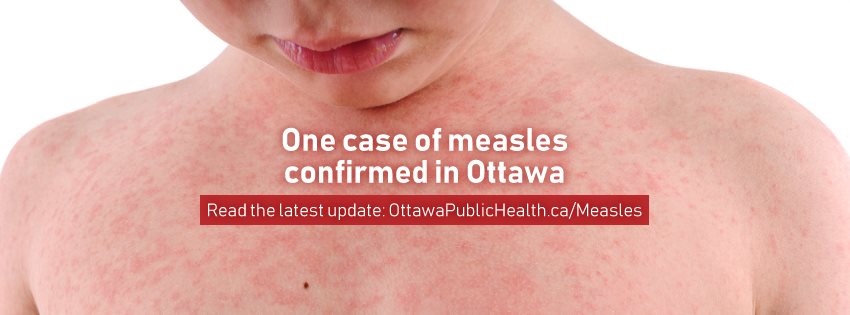 UPDATE: One case of measles confirmed in Ottawa